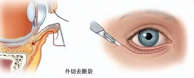好的技术？拉皮手术面部提升无锡苏州杭州AG真人平台app去除眼袋有什么比较(图1)